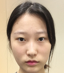 韩国一路美整形外科-一路美整形外科隆鼻案例对比