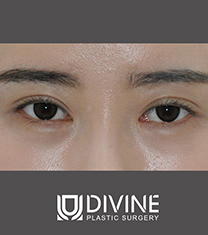 韩国DIVINE整形外科-韩国DIVINE整形外科埋线法矫正上睑下垂真人前后对比