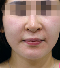 韩国美lab皮肤科埋线提升案例对比