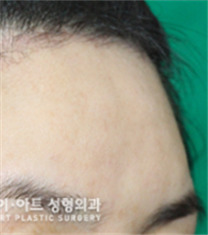 韩国K-Art整形外科额头再手术整形案例_术前