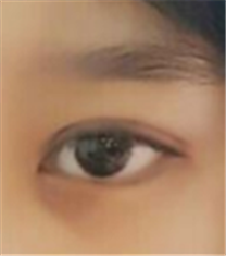 韩国乐美尔整形外科眼部整形案例
