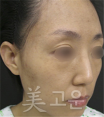 韩国美高恩整形外科祛斑案例对比