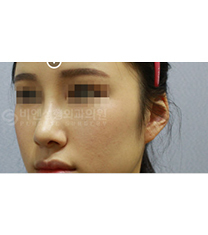 韩国BN整形外科鼻综合日记真人对比日记