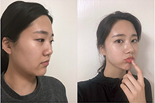 韩国koko鼻整形医院，4分钟看懂做鼻子案例+特色！
