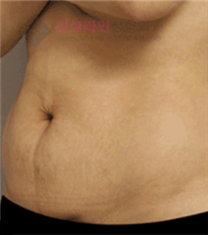 韩国三星line整形外科腹部吸脂整形案例_术前