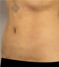 韩国三星line整形外科腹部吸脂整形案例