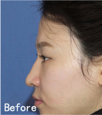 韩国三星line鼻整形案例对比图