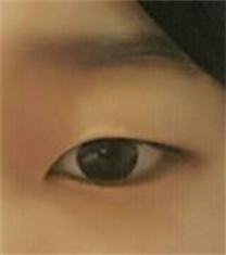 韩国乐美尔整形外科眼部整形日记