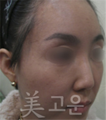 韩国美高恩整形外科祛斑案例对比_术后