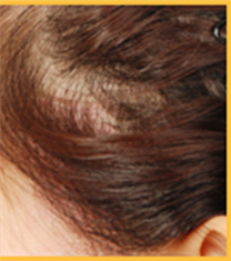 韩国毛爱林伤疤毛发移植案例对比图