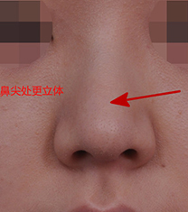 韩国韩娜鼻整形医院-韩国韩娜鼻整形外科无假体鼻整形日记对比
