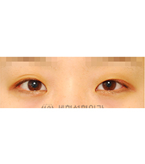 韩国世现整形外科全切双眼皮30天真人案例对比