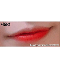 韩国Beautybar注射玻尿酸微笑唇整形案例对比_术前