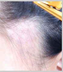 韩国毛爱林伤疤毛发移植案例对比图
