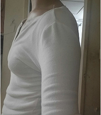 韩国Glam整形外科假体隆胸3个月前后对比