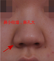 韩国韩娜鼻整形外科无假体鼻整形案例对比
