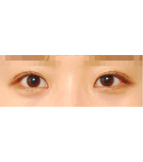 韩国世现整形外科全切双眼皮30天真人日记对比