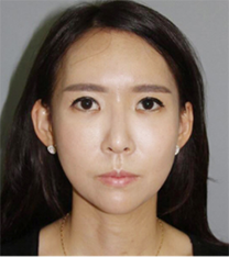 韩国able整形医院自体脂肪面部填充手术案例
