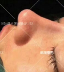 宁波韩美整形医院肋软骨隆鼻手术案例
