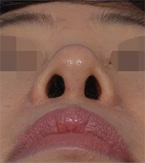 韩国韩娜整形医院鼻翼缩小手术对比案例_术后