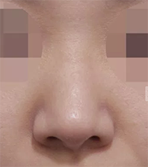 韩国韩娜整形医院鼻部修复手术对比案例_术后
