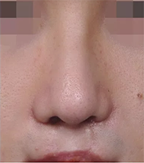韩国韩娜整形医院唇裂鼻整形手术案例
