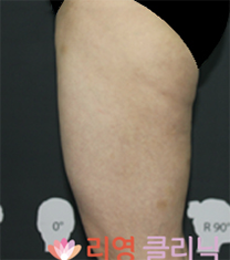韩国丽颖整形医院大腿吸脂手术对比案例_术前