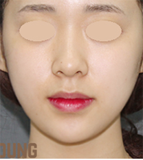 韓國麗穎整形醫院面部輪廓整形手術案例