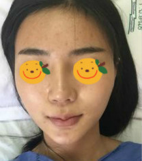 泰国Yanhee然禧国际医院颧骨内推手术真人案例