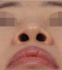 韩国韩娜整形医院鼻翼缩小手术对比日记