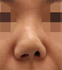 韩国韩娜整形医院鼻部修复手术对比案例