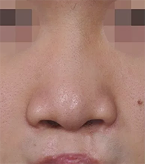 韩国韩娜整形医院唇裂鼻整形手术案例