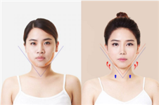 什么是下颌角整形，韩国和国内手术区别有哪些？