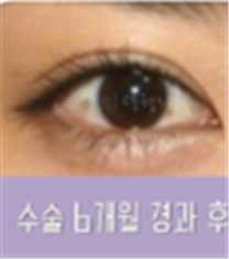 韩国特艺整形外科眼部整形案例