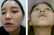 韩国医院做下巴整形术后60天恢复过程！