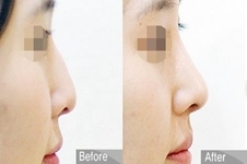 韩国OLIVE整形外科鼻综合手术跟will医院相比哪个效果更好？