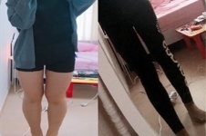 韩国医院大腿吸脂术后60天恢复图！