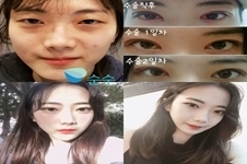 韩国gio整形医院跟纯真相比，哪家做双眼皮效果更好？