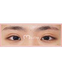 韩国Misoline整形外科-韩国misoline整形外科双眼皮修复对比日记曝光