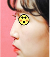 韩国Baroko整形外科-韩国Baroko整形外科隆鼻手术前后对比图