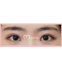韩国misoline整形外科双眼皮修复对比案例曝光