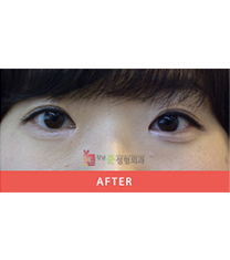 韩国江南琼(june)整形双眼皮手术案例对比_术后