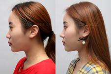 鼻中隔手术后鼻子塌陷是真是假？韩国常用什么抬高鼻梁？