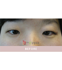 韩国江南琼(june)整形双眼皮手术案例对比