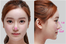 韩国做鼻中隔隆鼻可以修复吗，修复常用什么材料不发炎？