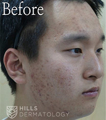韩国Hills希尔皮肤科男士痘肌护理全过程