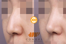 韩国cocoline和高诺鼻谁做驼峰鼻改善更明显？