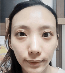 韩国延世PLUS整形医院眼底脂肪重置手术对比案例