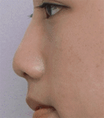 韩国延世PLUS整形医院隆鼻手术对比日记