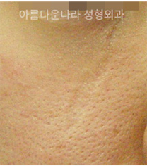 韩国吴金斯整形外科面部祛疤手术对比案例
